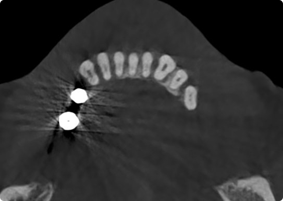 Before metal artifact reduction